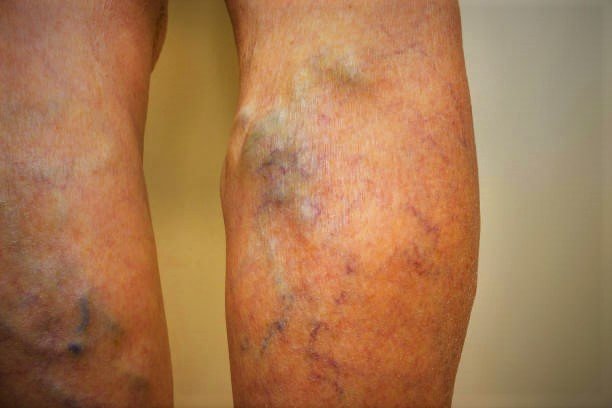 Best Doctor For Varicose Veins In Faridabad