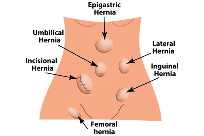 Best Hernia Repair Treatment In  Faridabad